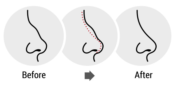 a nose showing before and after dorsal hump reduction