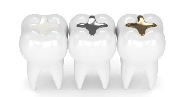 two teeth with amalgam fillings