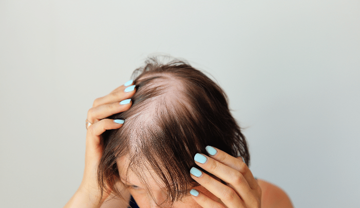 Modern hair loss treatments - a woman with thinning hair